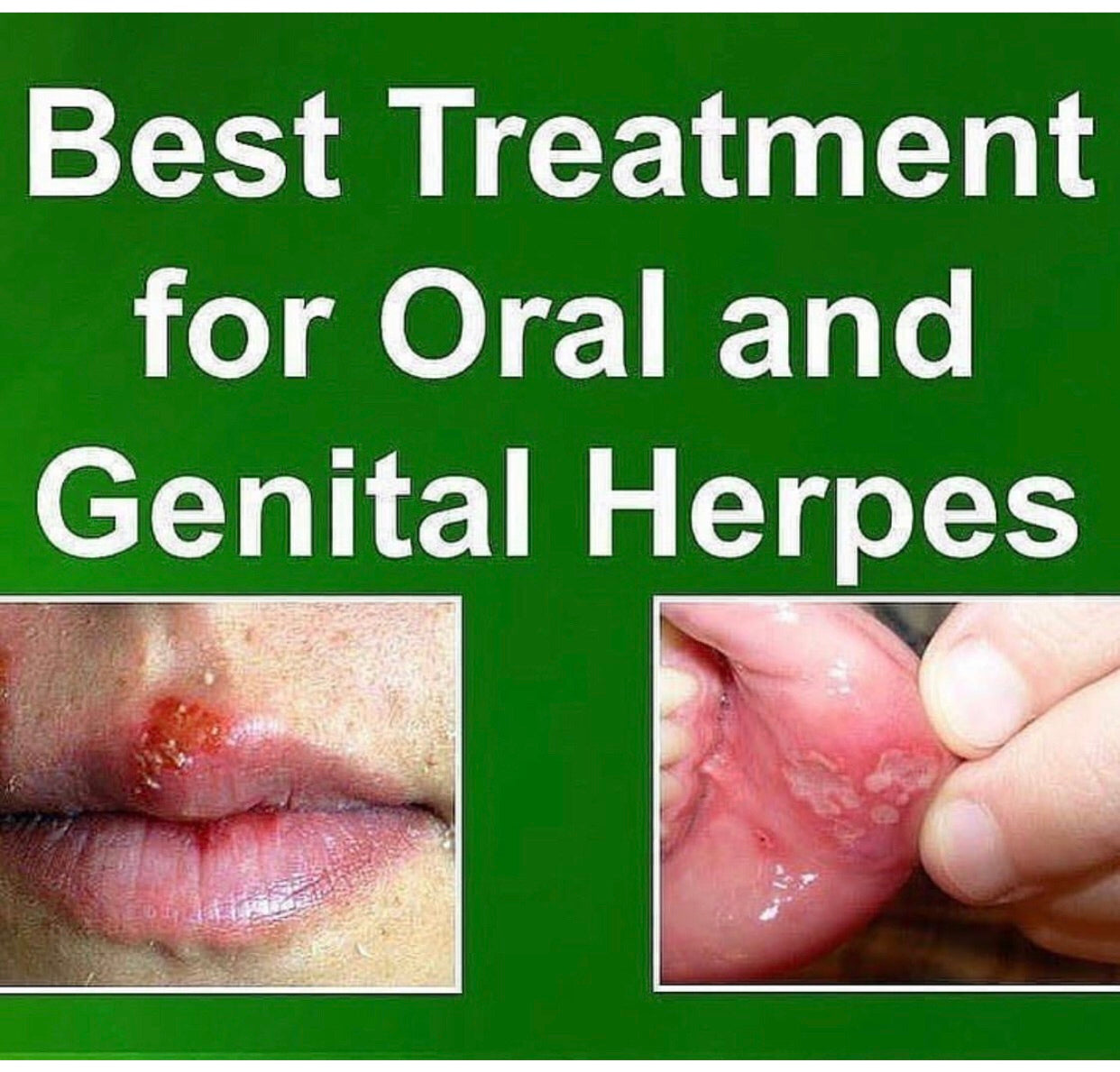 Herpes Formula